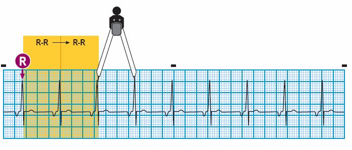 Module: ECG Module Lesson: Junctional Rhythms Section: Slide: 25 ECG Criteria P wave before or after QRS or not