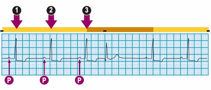 Module: ECG Module Lesson: Junctional Rhythms Section: Slide: 30 Premature Junctional Contraction (PJC) P Analyze the example: -P waves are present do not look the same.