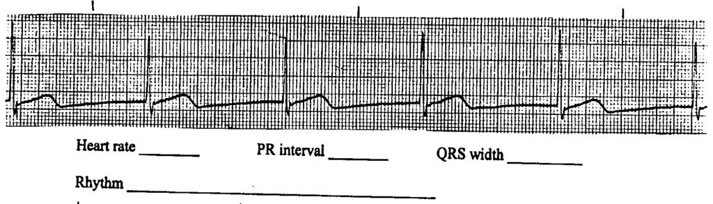 5 Lead V1 P waves PR interval QRS QRS interval Vent.