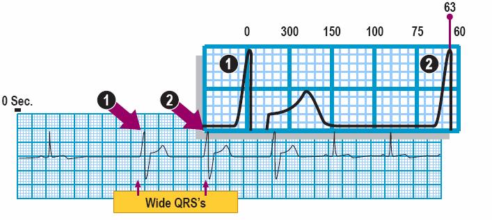 Module: ECG Module Lesson: Ventricular Rhythms Section: Slide: 9