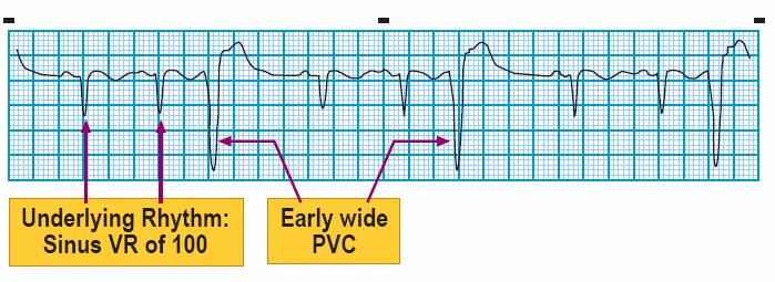 Module: ECG Module Lesson: Ventricular Rhythms Section: Slide: 13 PVC Criteria PVCs originate below the bundle of His from an irritable focus in the ventricle.