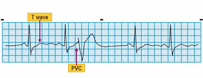Module: ECG Module Lesson: Ventricular Rhythms Section: Slide: 15 PVC R on T Electrical impulse occurring during