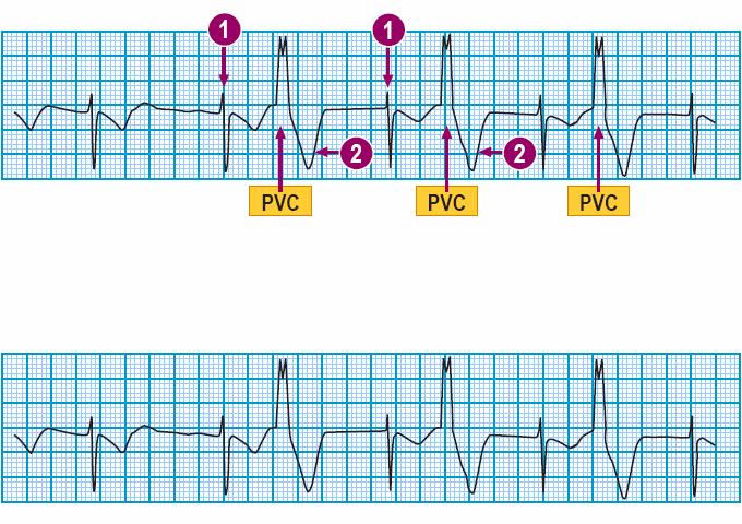 Module: ECG Module Lesson: Ventricular Rhythms Section: