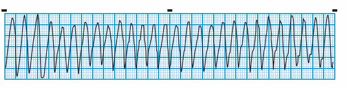 Module: ECG Module Lesson: Ventricular Rhythms Section: Slide: 20 Ventricular Tachycardia Priy Rhythm Summary Idioventricular