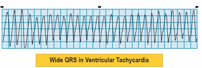 Module: ECG Module Lesson: Ventricular Rhythms