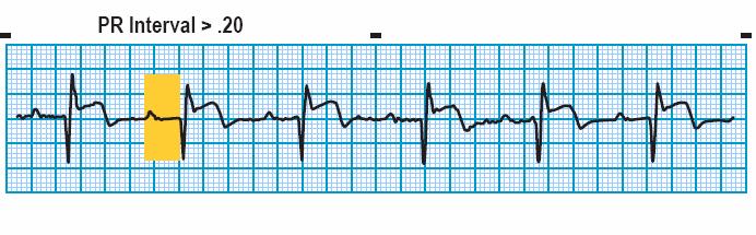 Module: ECG Module Lesson: Heart Block Section: Slide: 4 1 st Degree AV Block This rhythm strip also shows ST segment elevation.