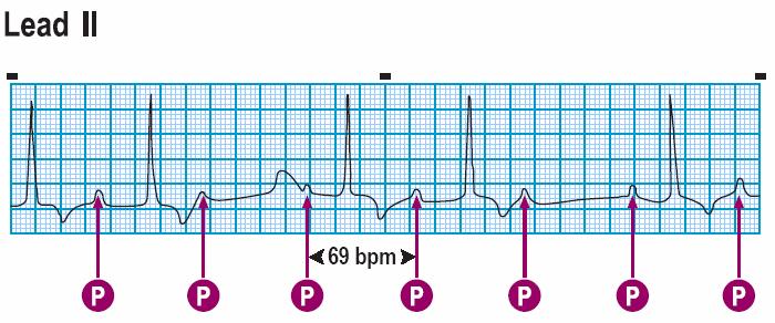 Module: ECG Module Lesson: Heart Block Section: Slide: 7 2 nd Degree