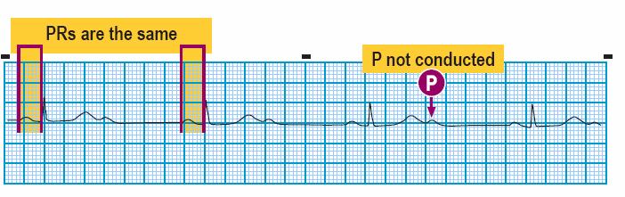 Module: ECG Module Lesson: Heart Block Section: Slide: 9 2 nd Degree Heart