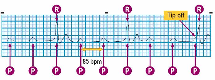 Module: ECG Module Lesson: Heart Block Section: Slide: 12 3 rd Degree Heart Block or Complete Heart Block In 3 rd