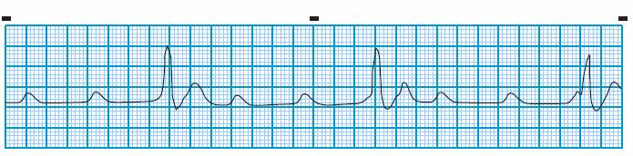P waves can be hidden in the QRS complex or the T wave, they can also be found at the beginning or end of the QRS