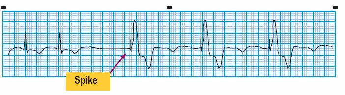Module: ECG Module Lesson: Heart Block Section: Slide: 17