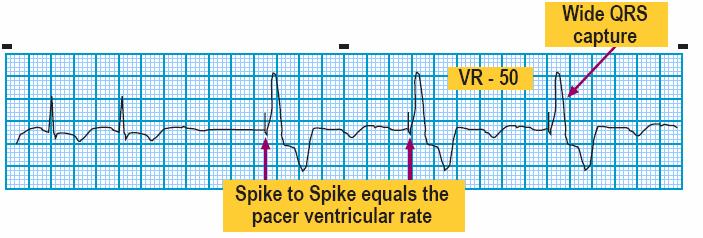 Module: ECG Module Lesson: Heart Block Section: Slide: 18