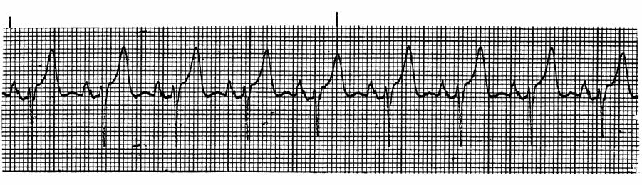 5 Lead II P waves PR interval QRS QRS interval Vent.