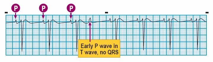 Module: ECG Module Lesson: Atrial Rhythms Section: Slide: 9 Premature Atrial Contraction (PAC) P wave