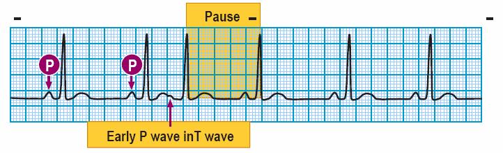 P wave early, easily identified and followed by normal ventricular depolarization.