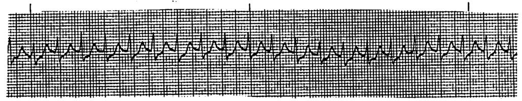 13 9 P waves PR interval QRS QRS interval Vent. Rate Vent.