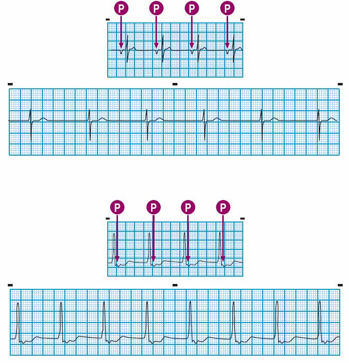 Module: ECG Module Lesson: Ventricular Rhythms Section: