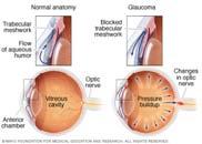 Diabetic retinopathy and glaucoma combined.