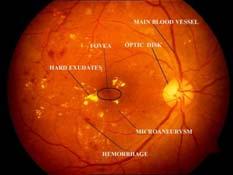 Signs/Symptoms of Diabetic Retinopathy How would you, the PCP know?