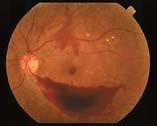 leukocytes in the retinal vasculature This leads to a loss of vascular