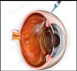 Anti VEGF therapy (reduces macular edema and retinal neovascularization)