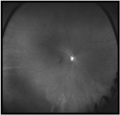 PERIPHERAL RETINA Can only be evaluated with