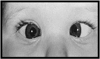 of good vision EXOTROPIA Eye turns outward Congenital present at birth Surgery usually needed to re-align Many
