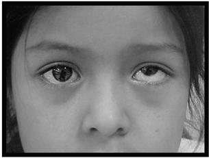 HYPERTROPIA One eye vertically misaligned Usually from paresis of an extra-ocular muscle Typically much more subtle for