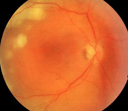 absence of) Vitreous cells / abnormalities Retinal
