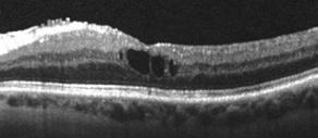 impact does uveitis make on activities of daily