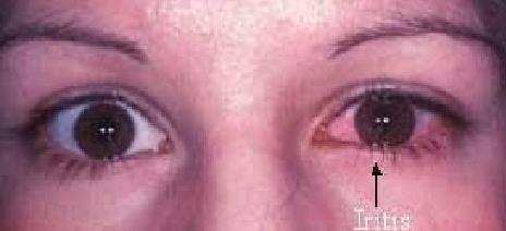 Acute Anterior Uveitis in JIA Subtypes Acute anterior uveitis is often associated with eye pain, redness, headache or photophobia Most common in HLA