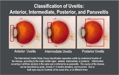 Uveitis Can last for a short (acute) or a long (chronic) time.