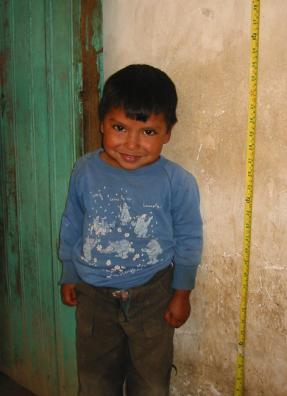 Health problems associated with undernutrition Stunting short height for age Due to chronic (long