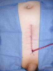 Invasiveness and Cosmesis No real advantage for laparoscopic/robotic Is laparoscopic surgery really less invasive? Six 1 inch incisions vs.