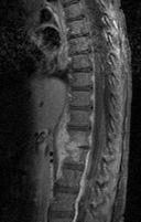 Is it in the back? Exclude Discitis! Pain in back!