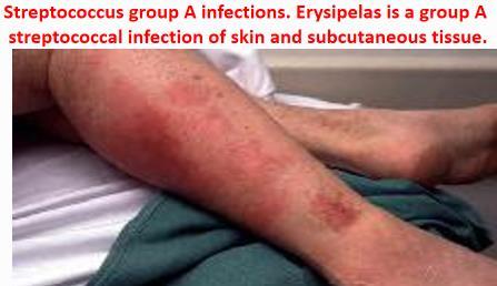DEFINITION A number of clinical syndromes caused by streptococcal infection.