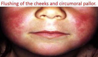 puffiness of the face skin or puerperal infection Major criteria Minor criteria hypertension 2. Strawberry tongue 1. Carditis 1. Fever smoky or rusty colored 3. Exanthem: The rash is usually fine 2.