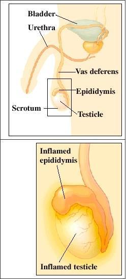 Epididymo-orchitis Pain, swelling and increased temperature of the Epididymis May involve the Testis and Scrotal skin.