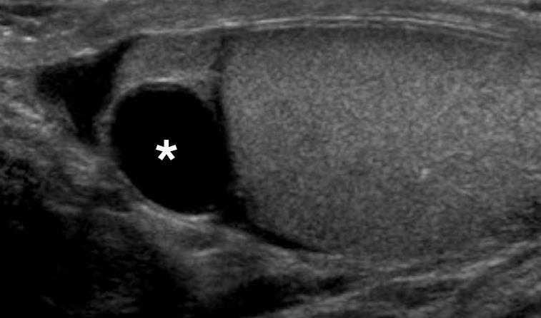 Epididymal Cyst Very Common 20-40 % of asymptomatic males on Ultrasound Attached to but