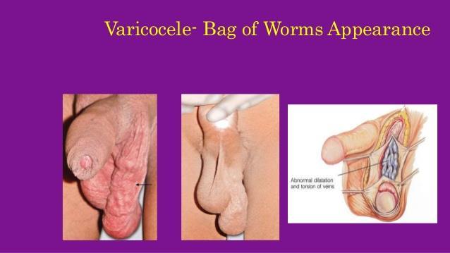 Risk of abnormal sperm production Varicocele Dilatation of veins of pampiniform plexus 12% of Adult