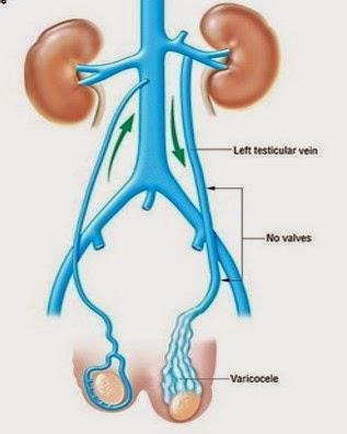 Varicocele Anatomy 90+ % left-sided Due to anatomy - left testicular vein 1. Is 8-10 cms longer than right 2.