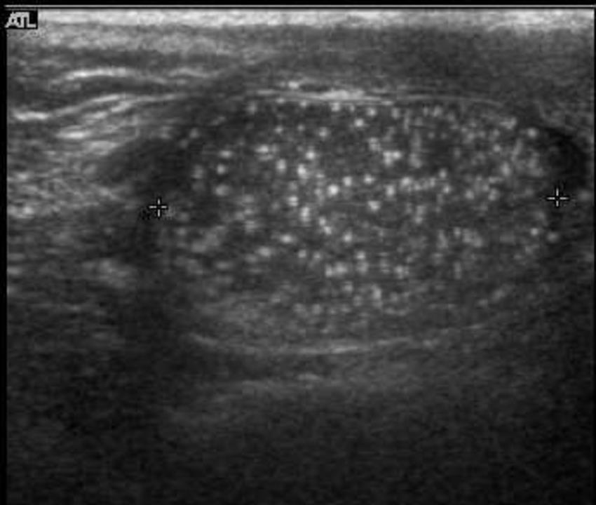Testicular Microcalcification Definition - 5 or more echogenic foci per highpowered view, in either