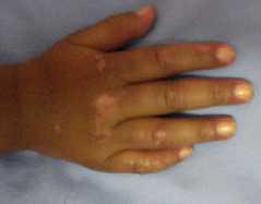 Specific Features: Skin Psoriasis White scaly plaques Vasculitis: Henoch Schonlein Purpura Kawasaki Disease Bechets Polyarteritis Nodosa SLE sjia Juvenile Dermatomyositis Sarcoidosis/Blau s disease