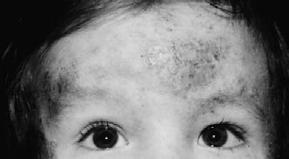 Pediatric Visual Dermatological