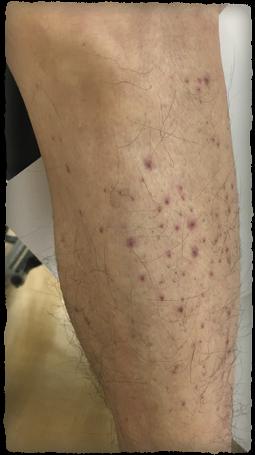dark stain in gingiva ecchymoses at right leg