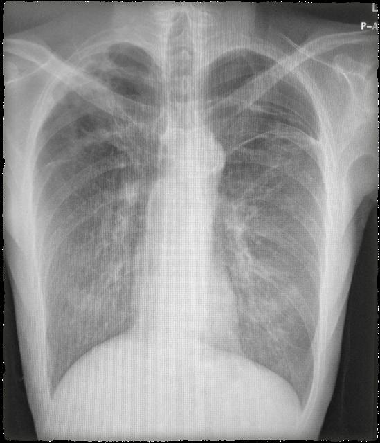 Chest X-ray bullas in both upper lung