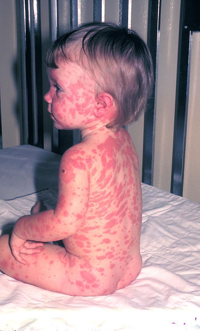Stevens Johnson Syndrome Pathophysiology Immune mediated hypersensitivity to exposure Clinical manifestations Extensive erythematous macules with central clearing Extensive mucosal involvement Fever,