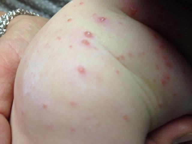 Varicella (Chicken Pox) Clinical manifestations Fever, malaise, pharyngitis, fussiness Vesicular rash with centripetal