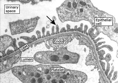 ANATOMY Integrity of glomerular filtration barrier is compromised Fenestrated endothelium