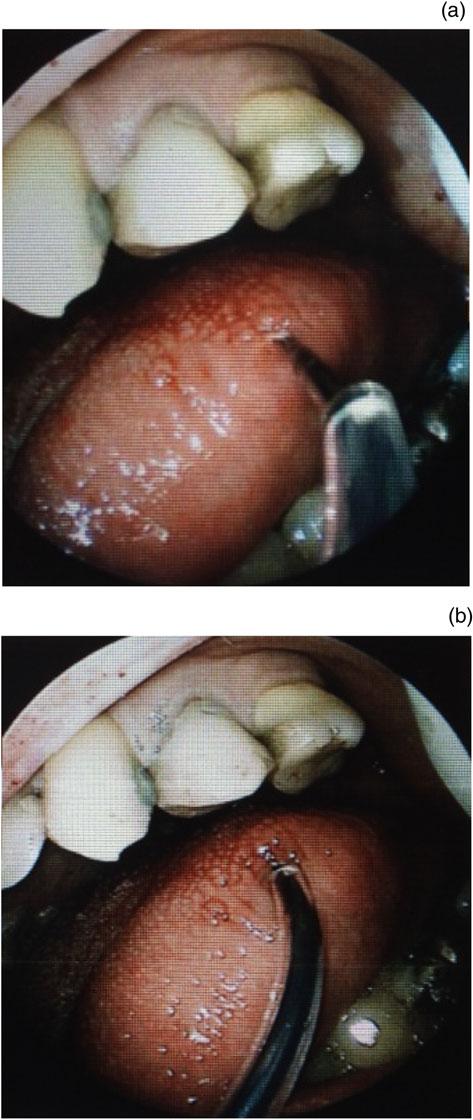 COBLATION-ASSISTED LEWIS AND MACKAY OPERATION 1223 hypertension, which contributes to the risk of tongue oedema and airway obstruction with extubation.